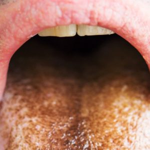 This Rare Case of Green Hairy Tongue Is Pure Nightmare Fuel